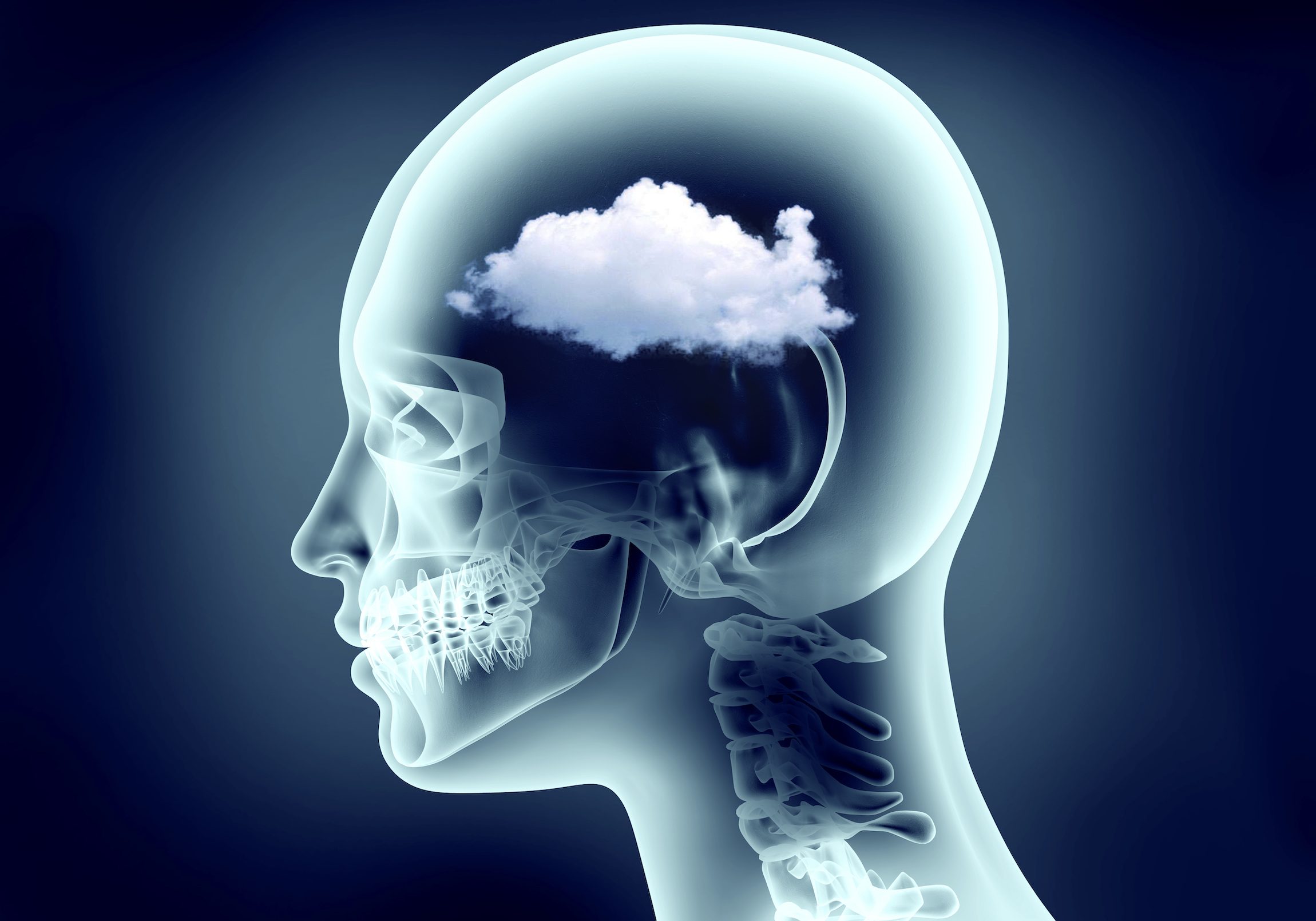 brain fog - shutterstock brain fog - shutterstock